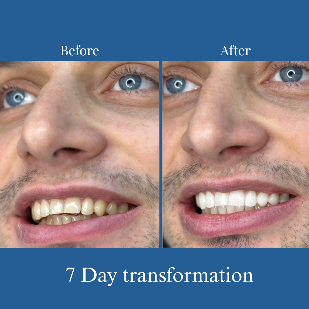 Omera's Instant Teeth Whitening Pen®