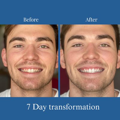 Omera's Instant Teeth Whitening Pen®